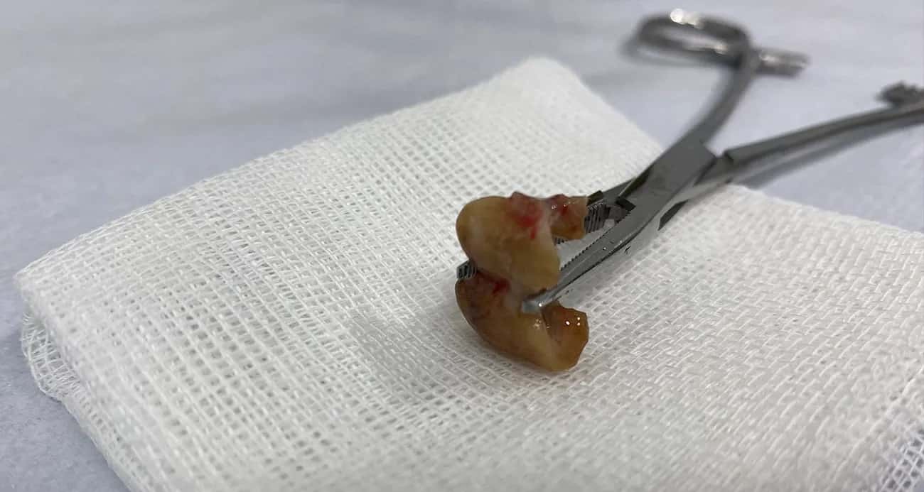 Uykusunda Dişlerini Yuttu, Nefes Borusundan Çıkarıldı!