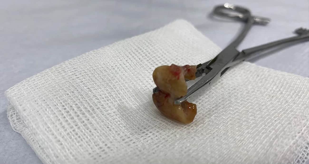 Uykusunda Dişlerini Yuttu, Nefes Borusundan Çıkarıldı!