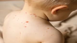 Aşısız Her 10 Çocuktan 9’u Kızamığa Yakalanıyor