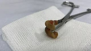 Uykusunda Dişlerini Yuttu, Nefes Borusundan Çıkarıldı!