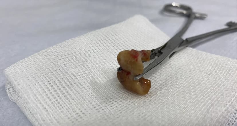 Uykusunda Dişlerini Yuttu, Nefes Borusundan Çıkarıldı!